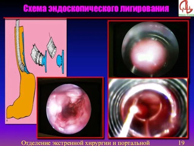 Отделение экстренной хирургии и портальной гипертензии Схема эндоскопического лигирования