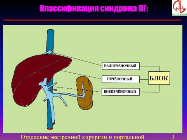 Отделение экстренной хирургии и портальной гипертензии Классификация синдрома ПГ: