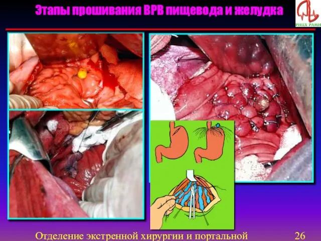 Отделение экстренной хирургии и портальной гипертензии Этапы прошивания ВРВ пищевода и желудка