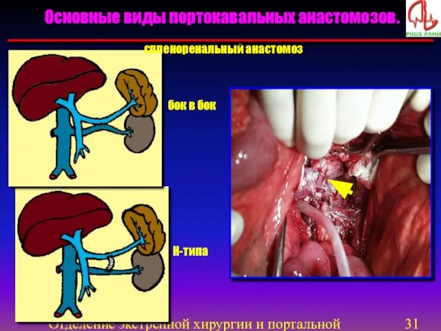 Отделение экстренной хирургии и портальной гипертензии Н-типа спленоренальный анастомоз Основные виды портокавальных анастомозов. бок в бок