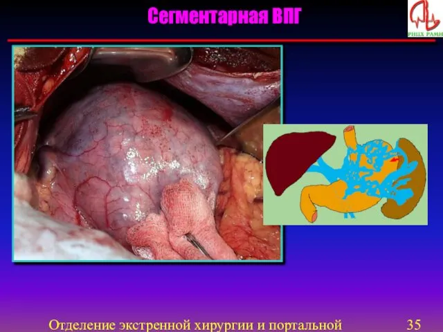 Отделение экстренной хирургии и портальной гипертензии Сегментарная ВПГ