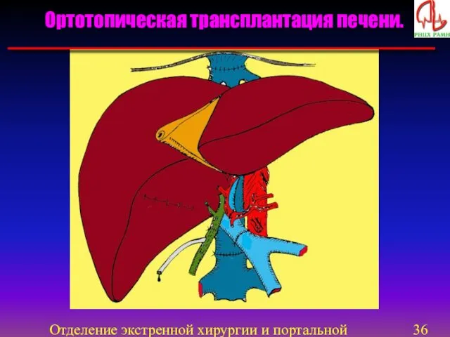 Отделение экстренной хирургии и портальной гипертензии Ортотопическая трансплантация печени.