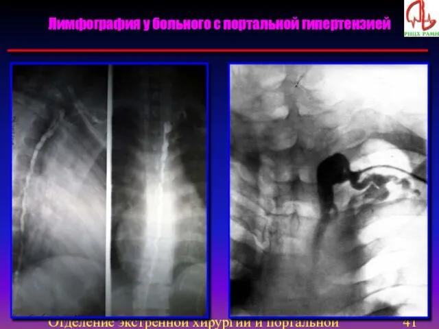 Отделение экстренной хирургии и портальной гипертензии Лимфография у больного с портальной гипертензией