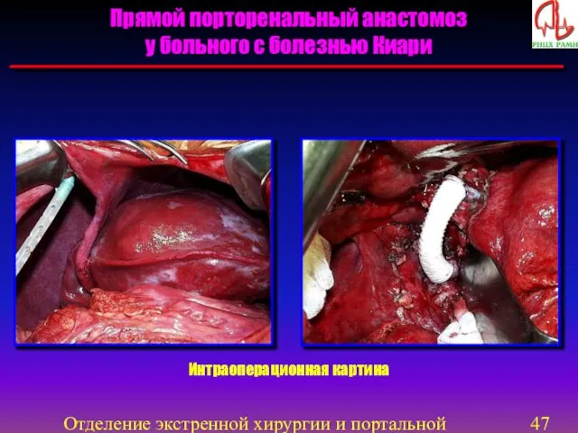 Отделение экстренной хирургии и портальной гипертензии Интраоперационная картина Прямой порторенальный анастомоз у больного с болезнью Киари