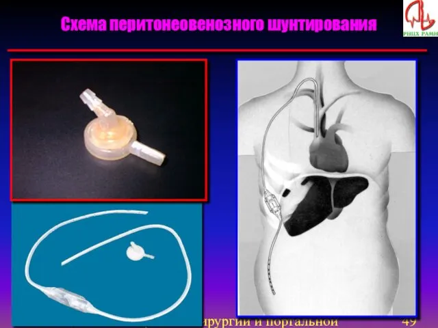 Отделение экстренной хирургии и портальной гипертензии Схема перитонеовенозного шунтирования