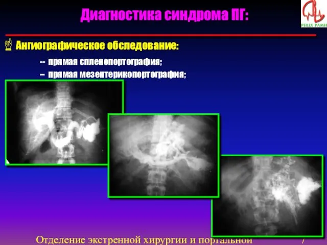 Отделение экстренной хирургии и портальной гипертензии Диагностика синдрома ПГ: Ангиографическое обследование: