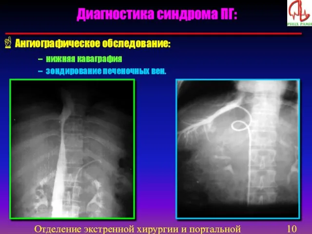 Отделение экстренной хирургии и портальной гипертензии Диагностика синдрома ПГ: Ангиографическое обследование: