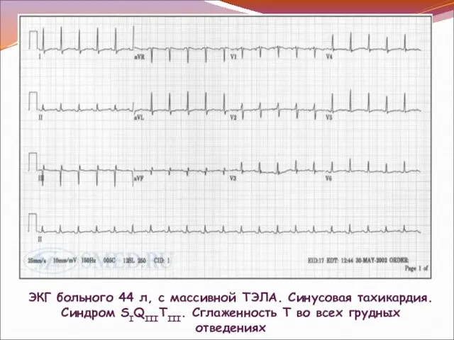 ЭКГ больного 44 л, с массивной ТЭЛА. Синусовая тахикардия. Синдром SIQIIITIII.