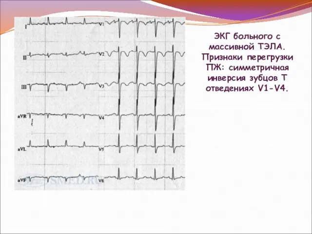 ЭКГ больного с массивной ТЭЛА. Признаки перегрузки ПЖ: симметричная инверсия зубцов Т отведениях V1-V4.