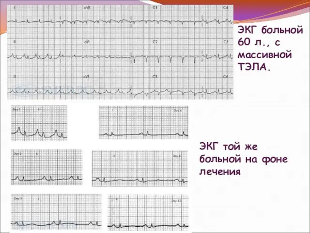 ЭКГ больной 60 л., с массивной ТЭЛА. ЭКГ той же больной на фоне лечения