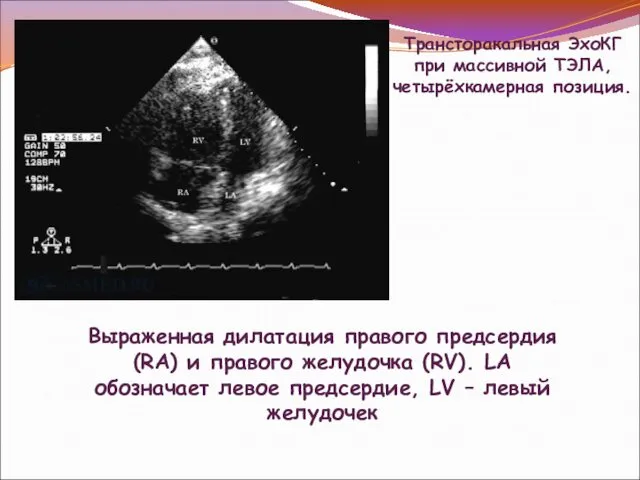 Трансторакальная ЭхоКГ при массивной ТЭЛА, четырёхкамерная позиция. Выраженная дилатация правого предсердия