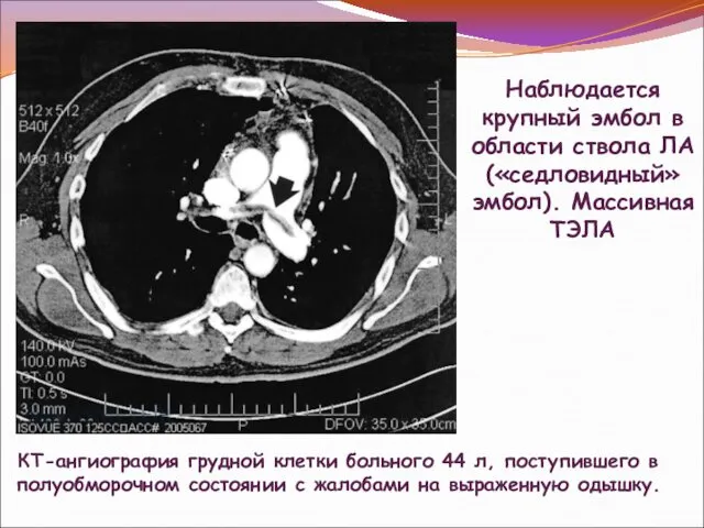 Наблюдается крупный эмбол в области ствола ЛА («седловидный»эмбол). Массивная ТЭЛА КТ-ангиография
