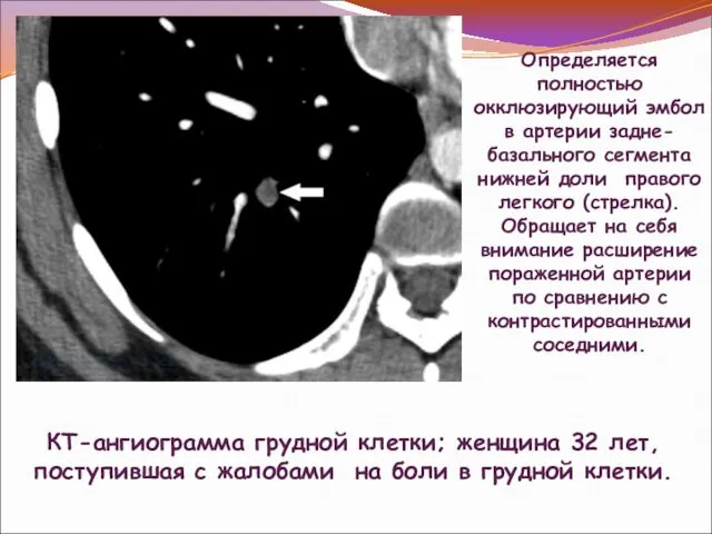 КТ-ангиограмма грудной клетки; женщина 32 лет, поступившая с жалобами на боли