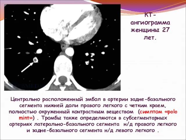 КТ-ангиограмма женщины 27 лет. Центрально расположенный эмбол в артерии задне-базального сегмента