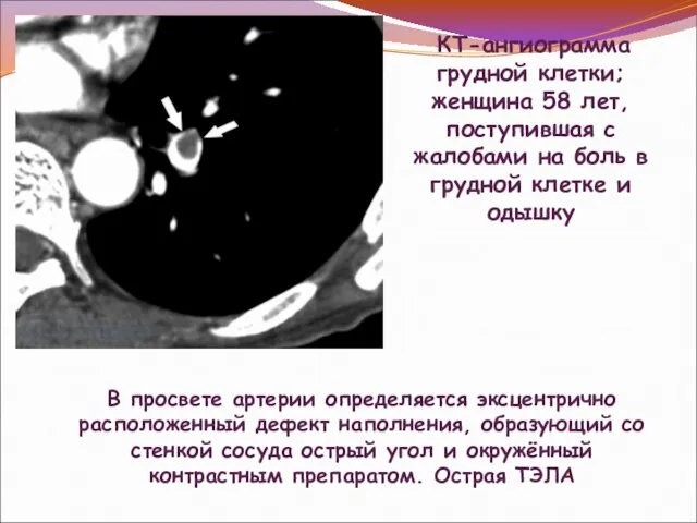 КТ-ангиограмма грудной клетки; женщина 58 лет, поступившая с жалобами на боль