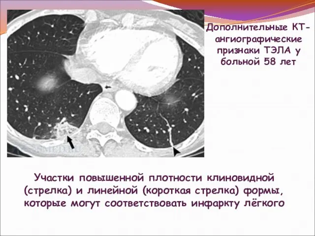 Участки повышенной плотности клиновидной (стрелка) и линейной (короткая стрелка) формы, которые