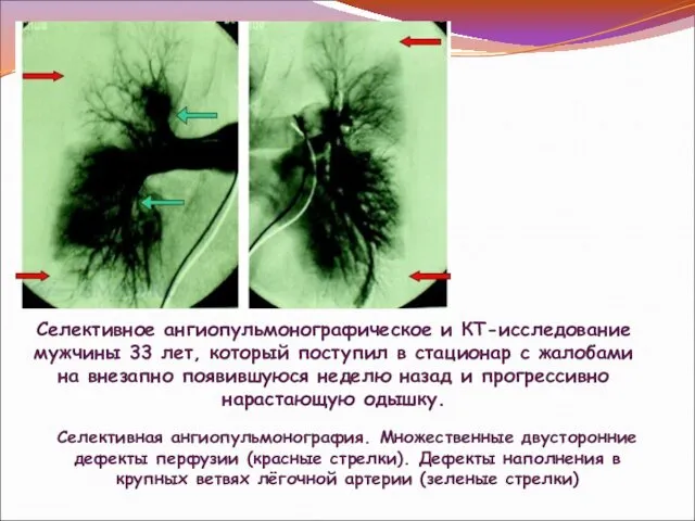 Селективное ангиопульмонографическое и КТ-исследование мужчины 33 лет, который поступил в стационар