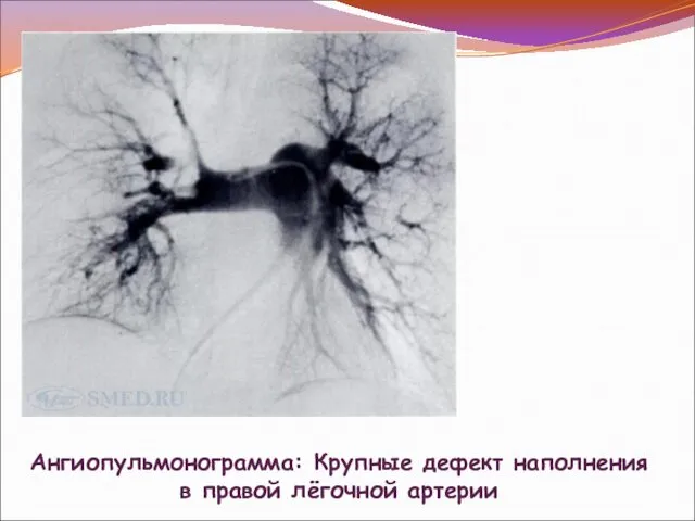 Ангиопульмонограмма: Крупные дефект наполнения в правой лёгочной артерии