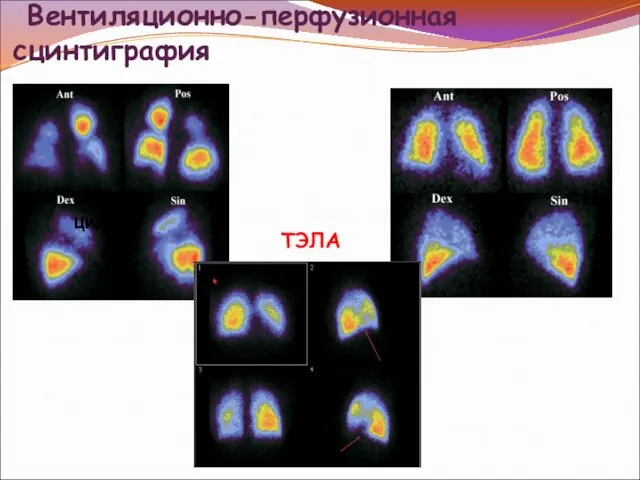 Вентиляционно-перфузионная сцинтиграфия вентиляция перфузия ТЭЛА