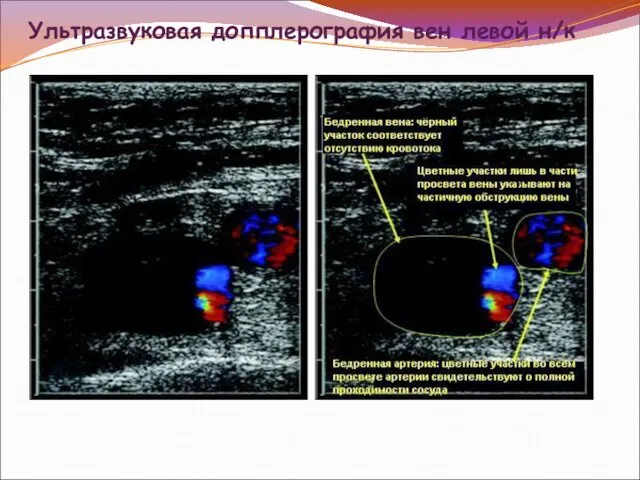Ультразвуковая допплерография вен левой н/к
