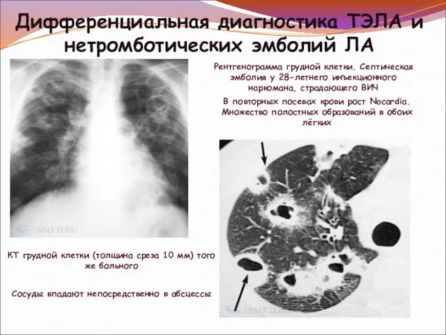 Дифференциальная диагностика ТЭЛА и нетромботических эмболий ЛА Рентгенограмма грудной клетки. Септическая