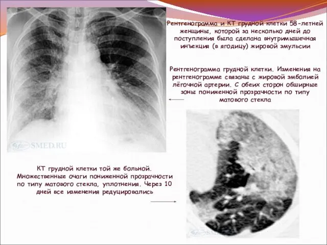 Рентгенограмма и КТ грудной клетки 58-летней женщины, которой за несколько дней