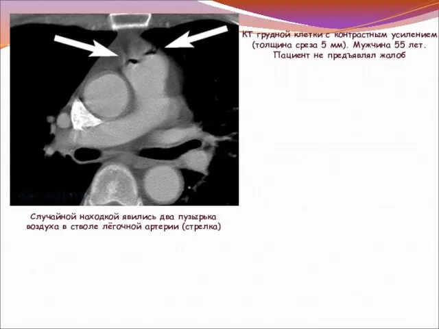 КТ грудной клетки с контрастным усилением (толщина среза 5 мм). Мужчина