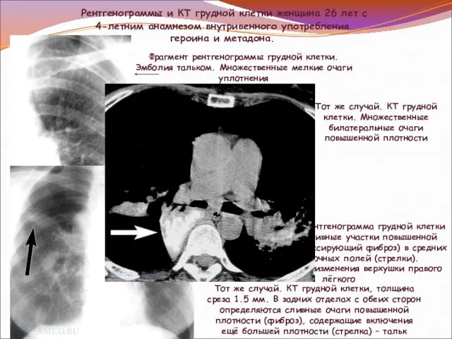 Рентгенограммы и КТ грудной клетки женщина 26 лет с 4-летним анамнезом