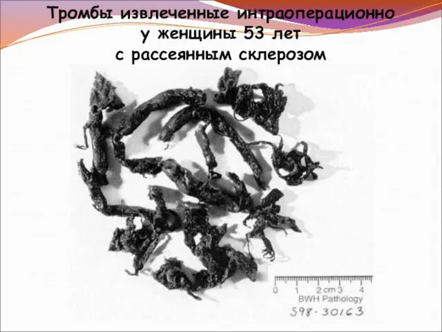 Тромбы извлеченные интраоперационно у женщины 53 лет с рассеянным склерозом