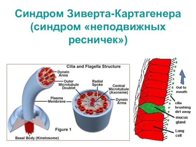 Синдром Зиверта-Картагенера (синдром «неподвижных ресничек»)