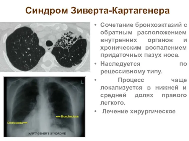 Синдром Зиверта-Картагенера Сочетание бронхоэктазий с обратным расположением внутренних органов и хроническим