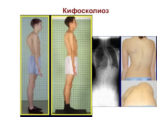 Кифосколиоз