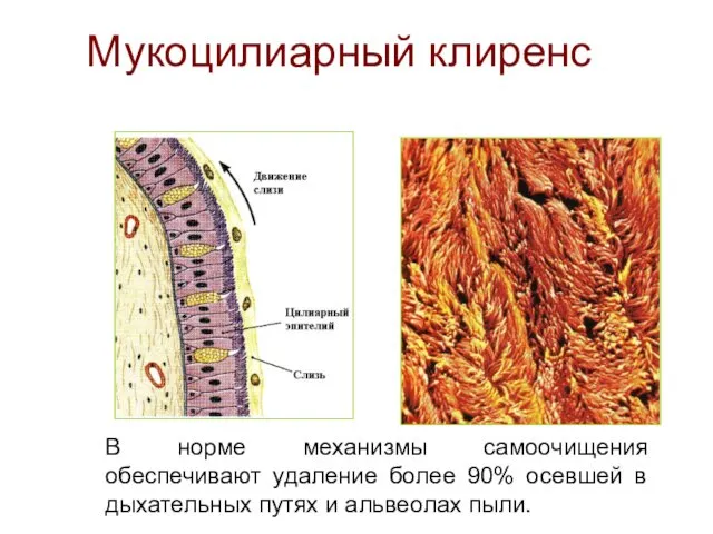 Мукоцилиарный клиренс В норме механизмы самоочищения обеспечивают удаление более 90% осевшей