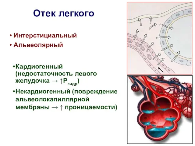 Отек легкого Интерстициальный Альвеолярный Кардиогенный (недостаточность левого желудочка → ↑Ргидр) Некардиогенный