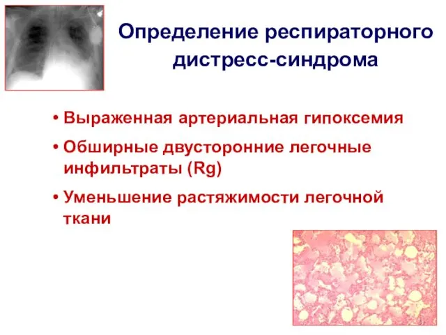 Определение респираторного дистресс-синдрома Выраженная артериальная гипоксемия Обширные двусторонние легочные инфильтраты (Rg) Уменьшение растяжимости легочной ткани