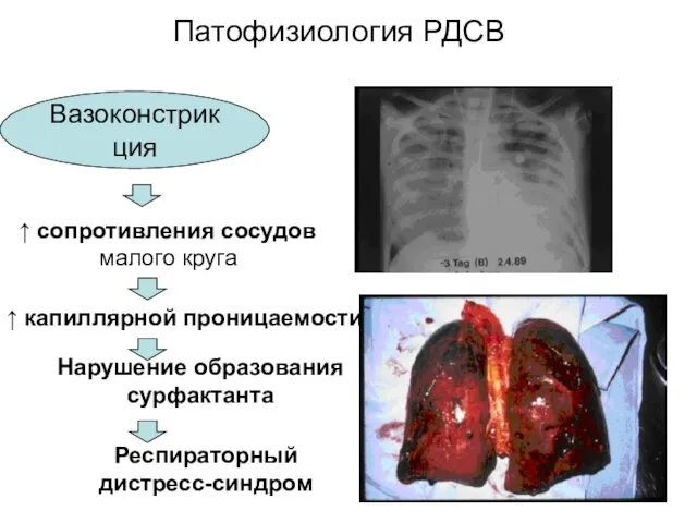Патофизиология РДСВ Вазоконстрикция ↑ сопротивления сосудов малого круга ↑ капиллярной проницаемости Нарушение образования сурфактанта Респираторный дистресс-синдром
