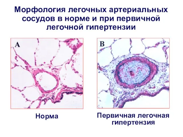 Морфология легочных артериальных сосудов в норме и при первичной легочной гипертензии Норма Первичная легочная гипертензия