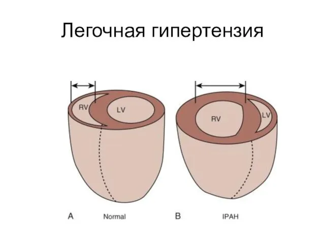 Легочная гипертензия