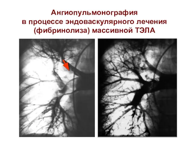 Ангиопульмонография в процессе эндоваскулярного лечения (фибринолиза) массивной ТЭЛА