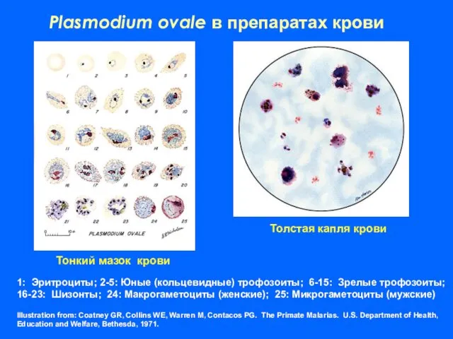 Plasmodium ovale в препаратах крови 1: Эритроциты; 2-5: Юные (кольцевидные) трофозоиты;