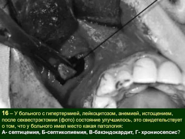 16 – У больного с гипертермией, лейкоцитозом, анемией, истощением, после секвестрэктомии