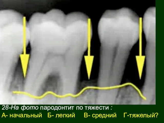 28-На фото пародонтит по тяжести : А- начальный Б- легкий В- средний Г-тяжелый?