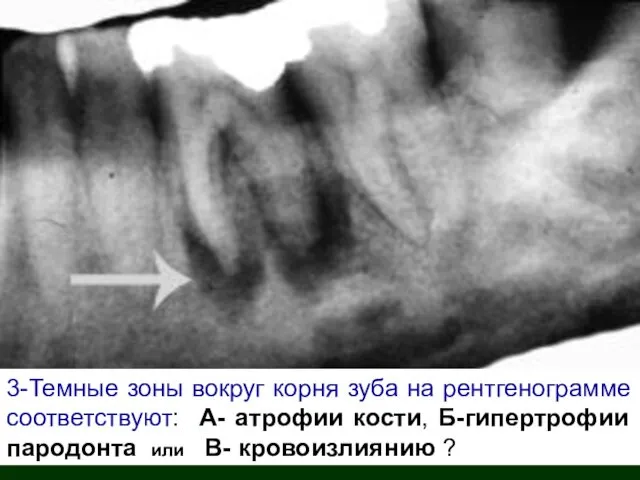 3-Темные зоны вокруг корня зуба на рентгенограмме соответствуют: А- атрофии кости,