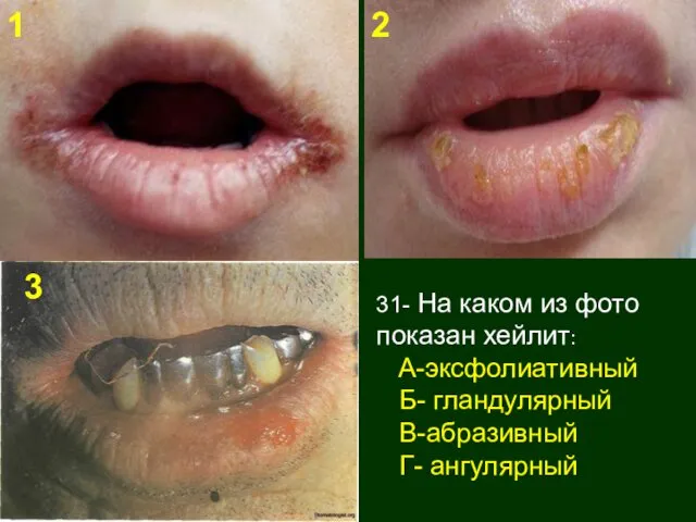 31- На каком из фото показан хейлит: А-эксфолиативный Б- гландулярный В-абразивный Г- ангулярный 3 1 2