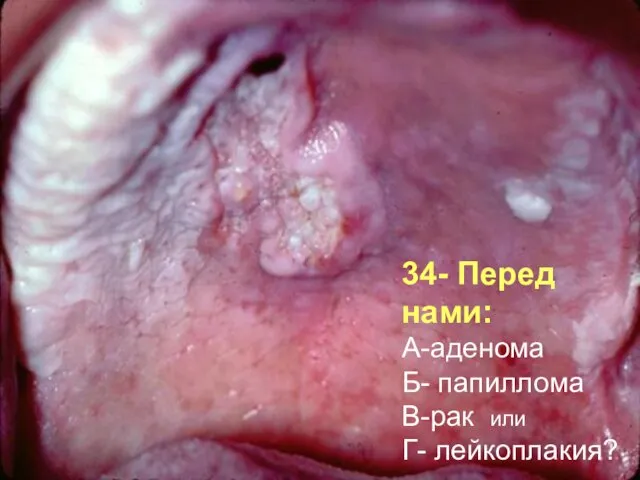 34- Перед нами: А-аденома Б- папиллома В-рак или Г- лейкоплакия?