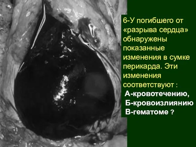 6-У погибшего от «разрыва сердца» обнаружены показанные изменения в сумке перикарда.