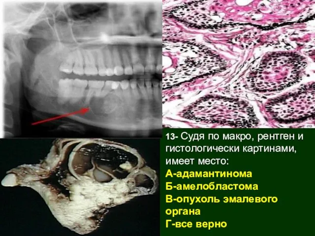 13- Судя по макро, рентген и гистологически картинами, имеет место: А-адамантинома