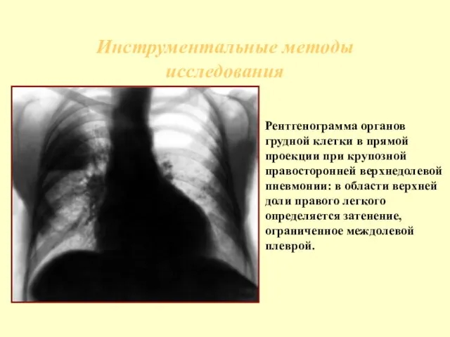 Инструментальные методы исследования Рентгенограмма органов грудной клетки в прямой проекции при