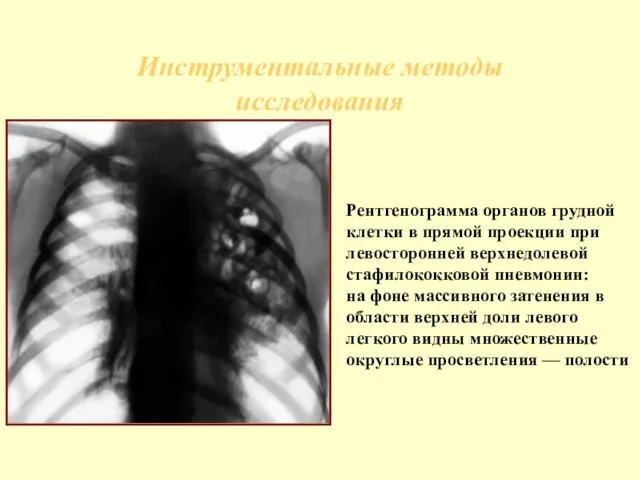 Инструментальные методы исследования Рентгенограмма органов грудной клетки в прямой проекции при