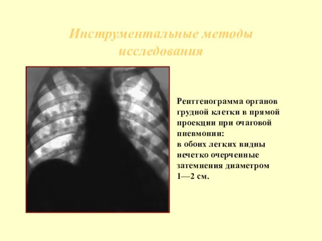 Инструментальные методы исследования Рентгенограмма органов грудной клетки в прямой проекции при